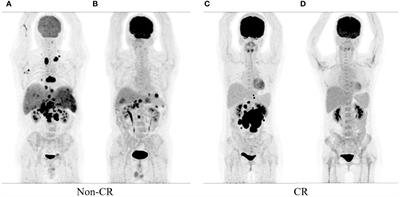 PET-based radiomic feature based on the cross-combination method for predicting the mid-term efficacy and prognosis in high-risk diffuse large B-cell lymphoma patients